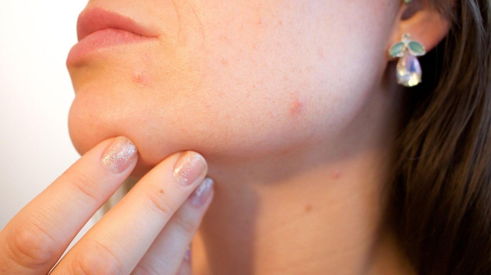 美容鍼で顔にあざができる原因とできやすい人は？正しいケアから予防まで詳しく解説
