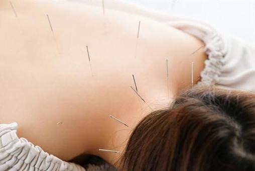 美容鍼の打つ場所はどう決まる？たるみ・ほうれい線に効く場所と効果の違いを解説！